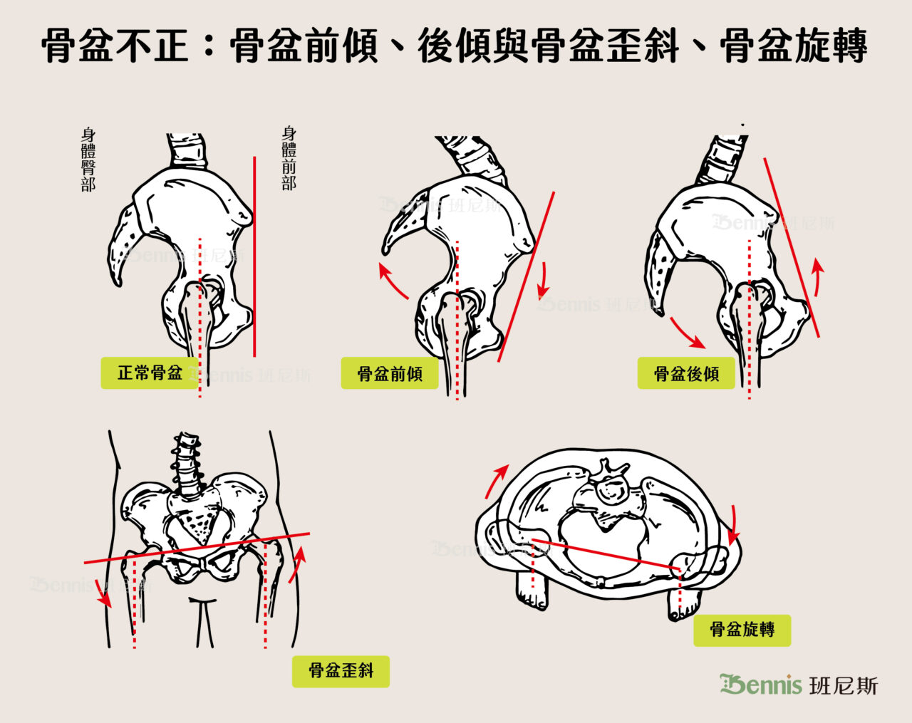 骨盆不正有骨盆前傾、後傾與骨盆歪斜、骨盆旋轉等情況，其中以骨盆前傾最常見。